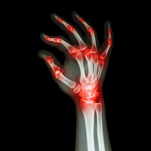 "Rheumatoid Arthritis , Gouty Arthritis"  (X-ray adult's hand with multiple arthritis)