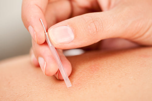 Macro detail of female hand using an insertion tube to insert a Goshin acupuncture needle in the back of a female patient.