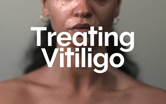 Treating Vitiligo